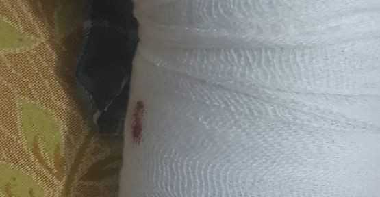 Siirt’te Köpek Saldırısına Uğrayan Genç Kız Yaralandı