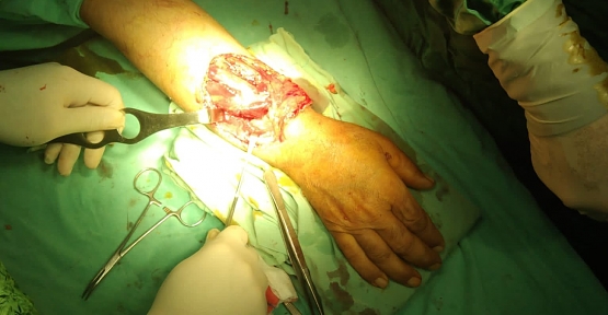 Özel Siirt Hayat Hastanesinde El Cerrahisinde Başarılı Ameliyatlar Yapılmaya Başlandı