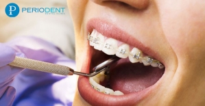 Ortodonti Diş Teli Fiyatları